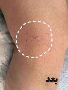 بعد از درمان واریس