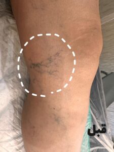 قبل از درمان واریس