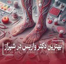 بهترین متخصص واریس پا در شیراز – آدرس+شماره تلفن