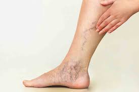 بهترین دکتر و عمل واریس پا در شیراز