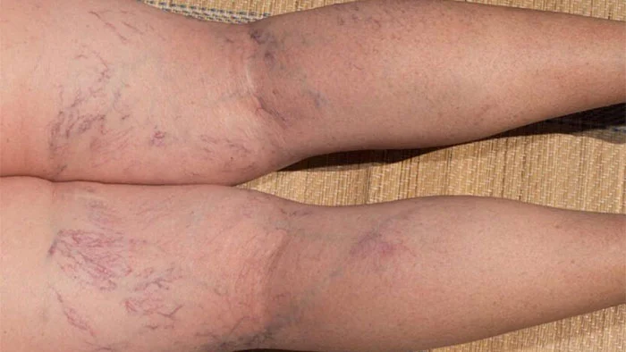 معیارهای انتخاب بهترین متخصص واریس پا در شیراز