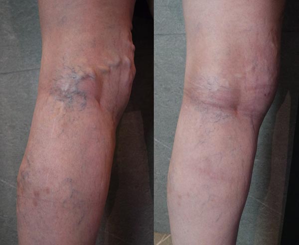 نشانه های اولیه واریس 