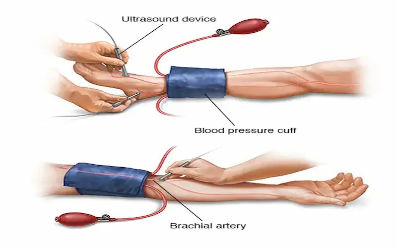 تست بررسی ABI — راهنمای کامل تشخیص گرفتگی عروق محیطی (PAD)، نحوه انجام، تفسیر نتایج و نوبت‌دهی