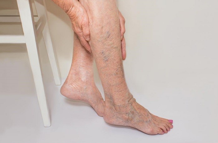 روش‌های درمان واریس پا در شیراز